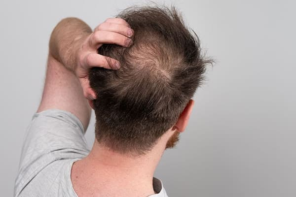 early-baldness-1